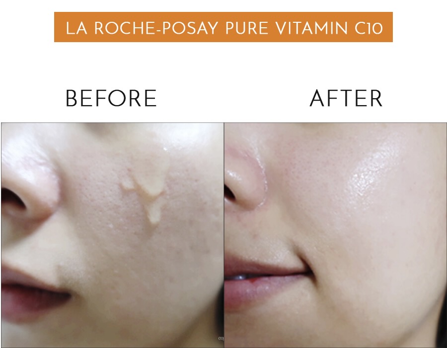 Review serum La Roche-Posay Vitamin C10 trị nám