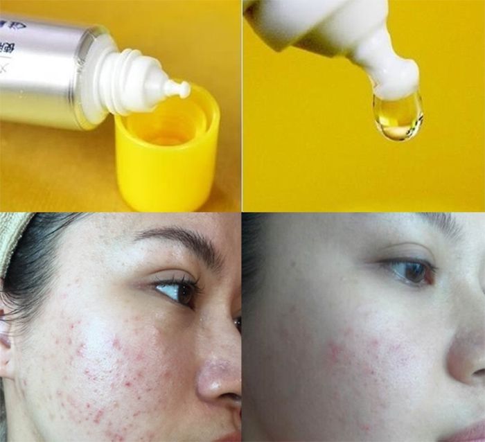 Review serum Melano CC trị thâm từ khách hàng