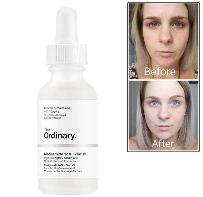 Hiệu quả trị mụn dưỡng sáng da của serum The Ordinary Niacinamide 10% + ZinC 1%